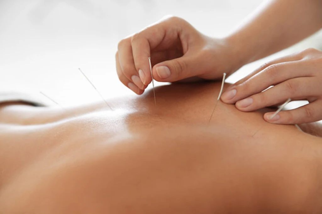 acupuncture