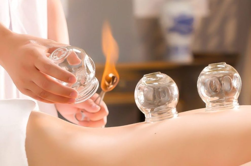cupping therapy