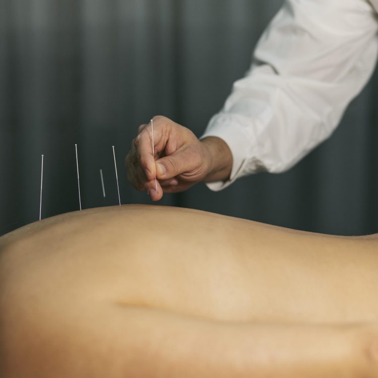 Acupuncture San Rafael