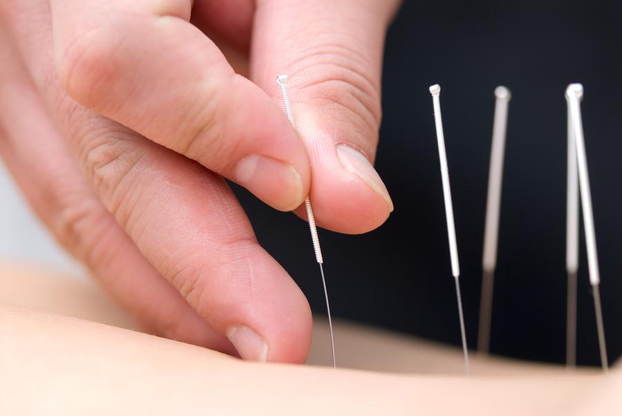 FAQs About Acupuncture