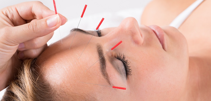 Unwind the Headache Cycle: Acupuncture for Migraines, Stress, and Bruxism