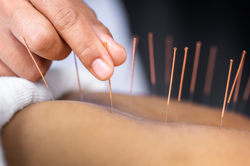 acupuncture Mill Valley CA