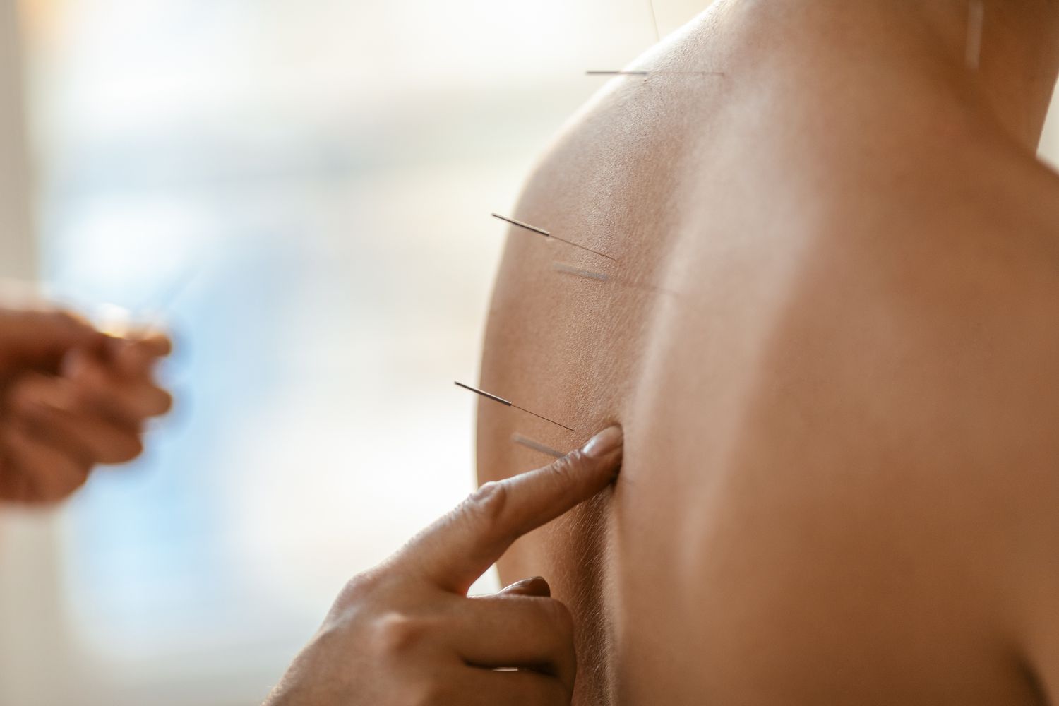 acupuncture Mill Valley