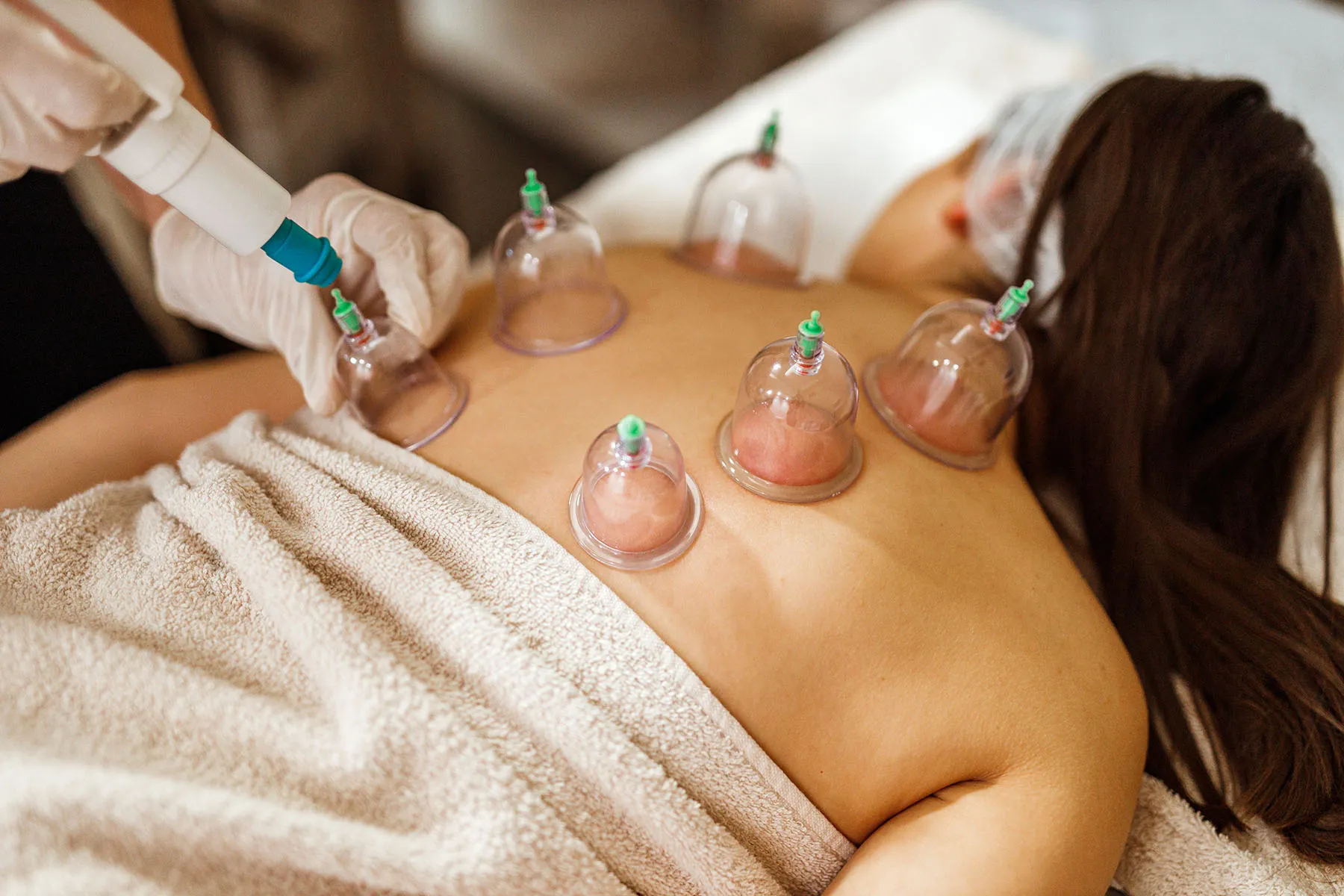 cupping therapy Norcal