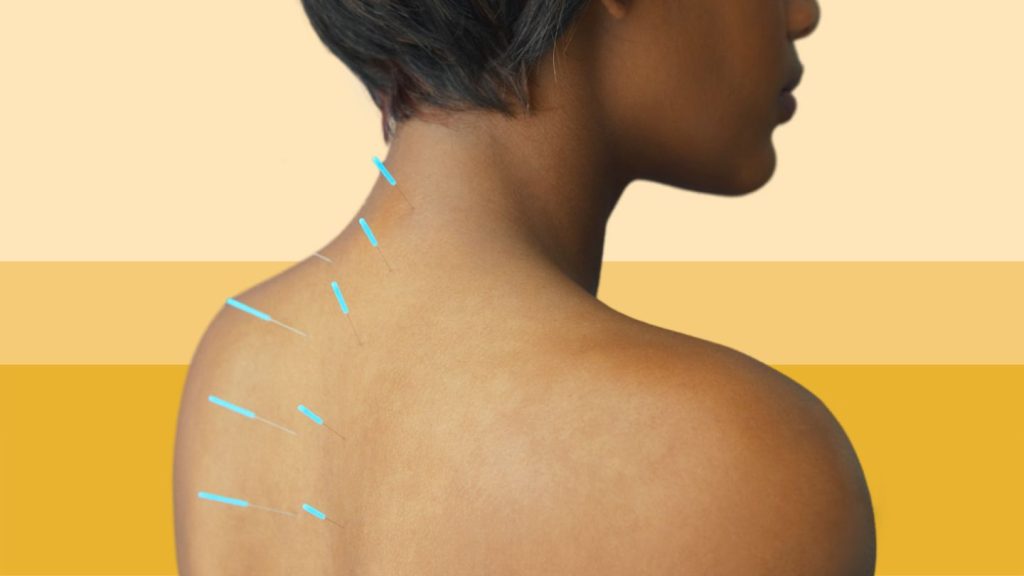 Acupuncture for People Who Don’t Believe in Acupuncture