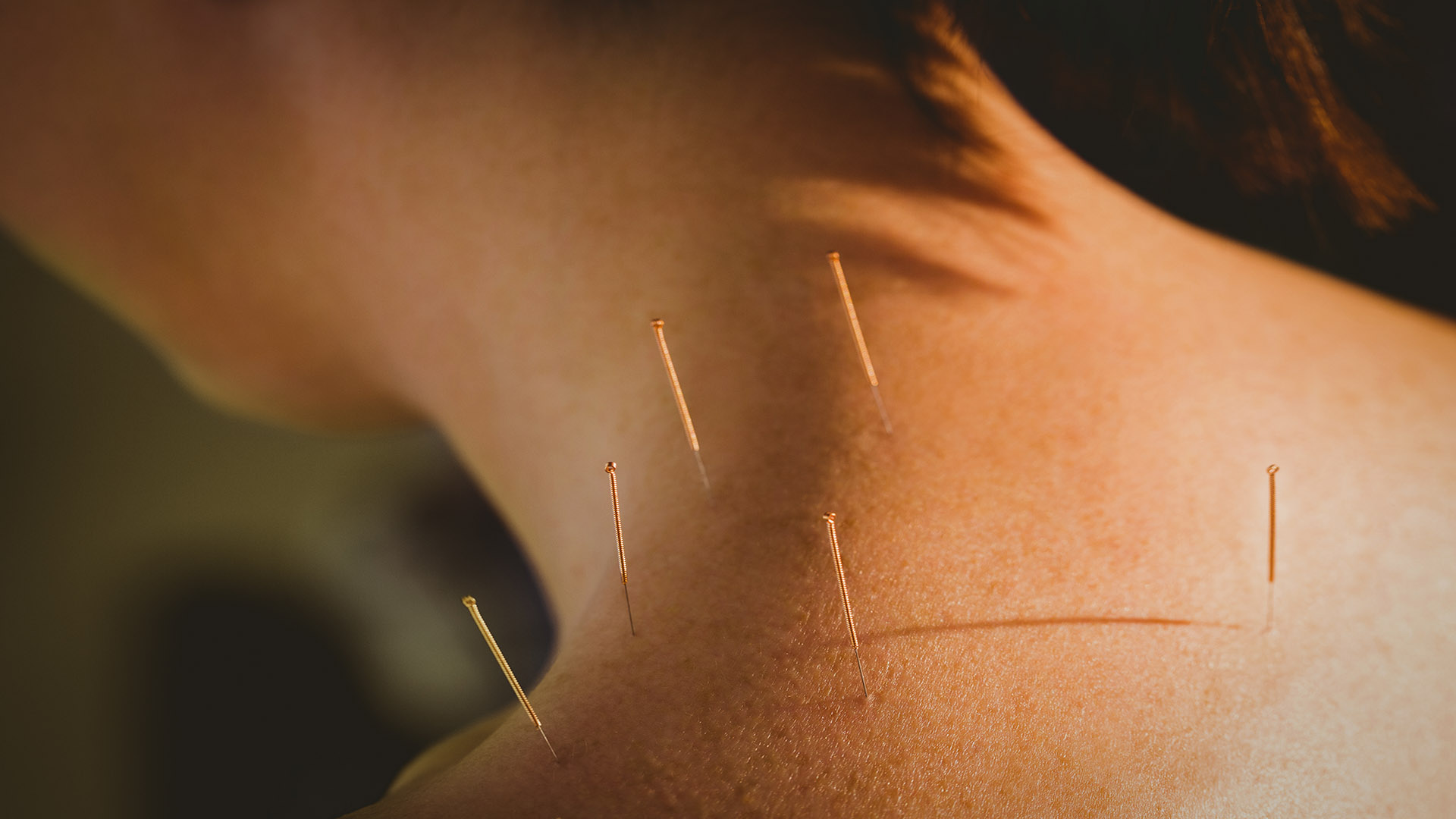 Acupuncture for People