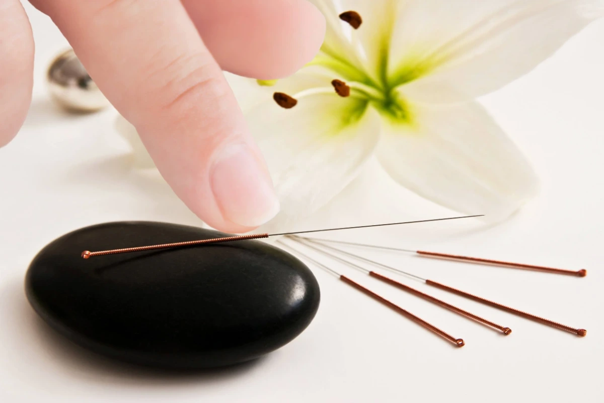 Acupuncture (1)