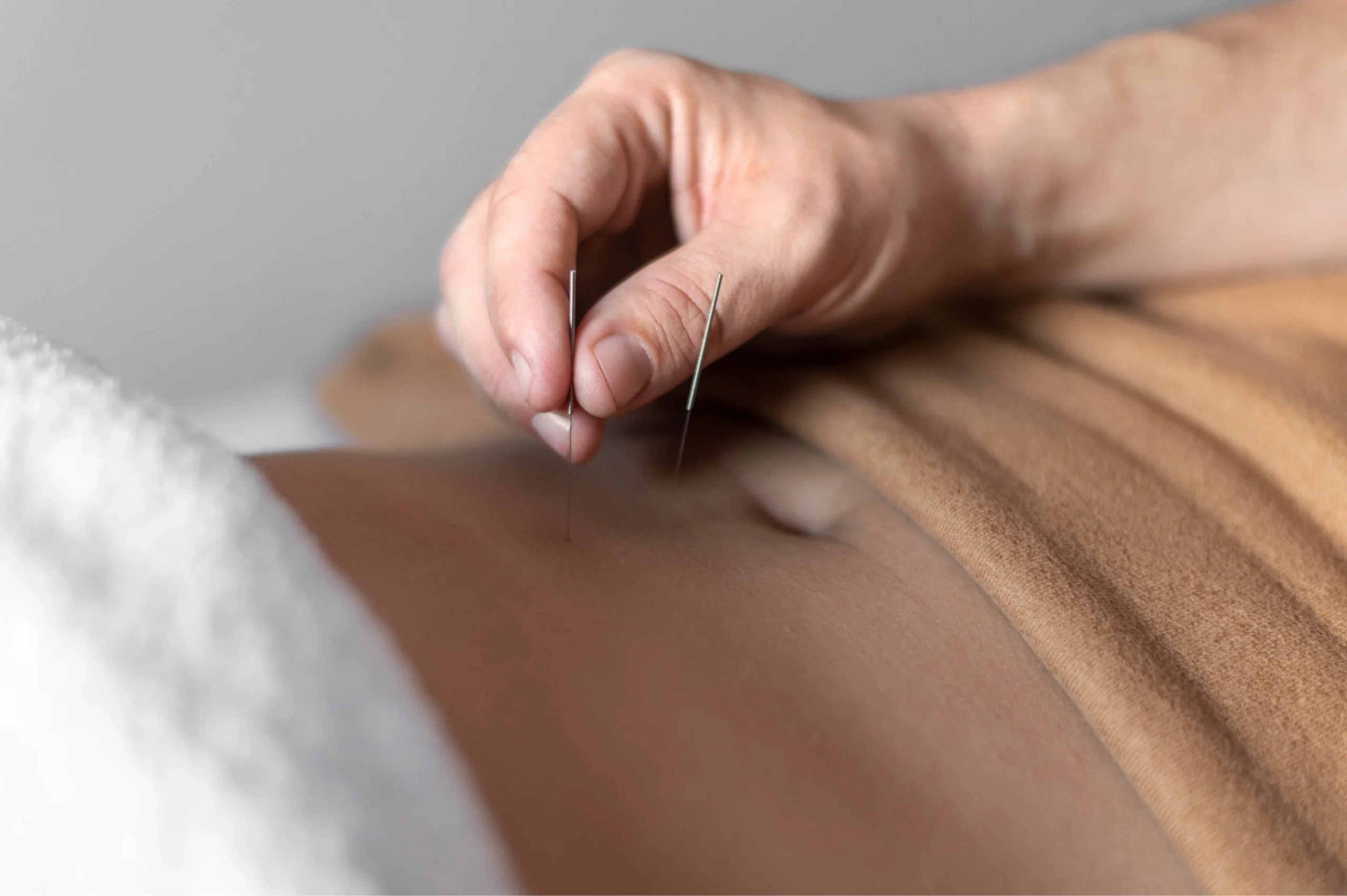 Acupuncture Serving Marin County