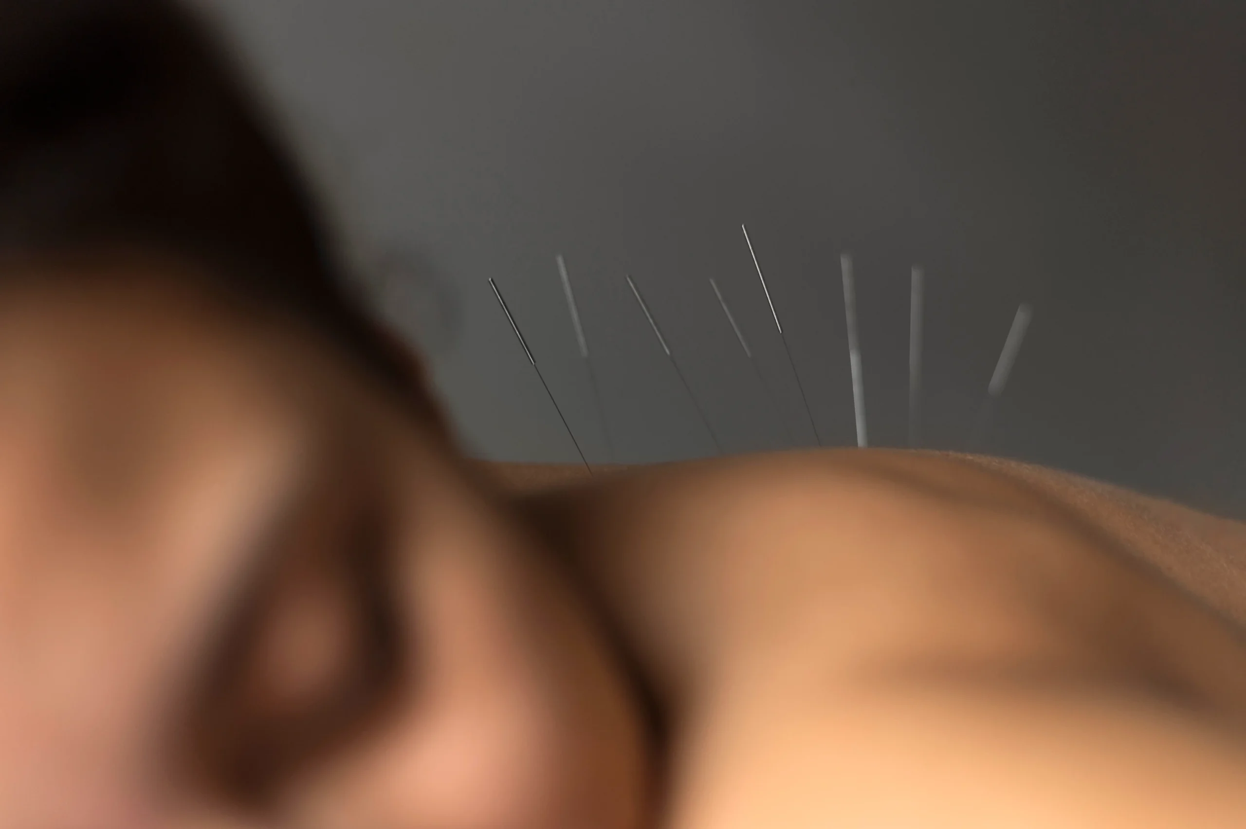 Acupuncture in Mill Valley CA
